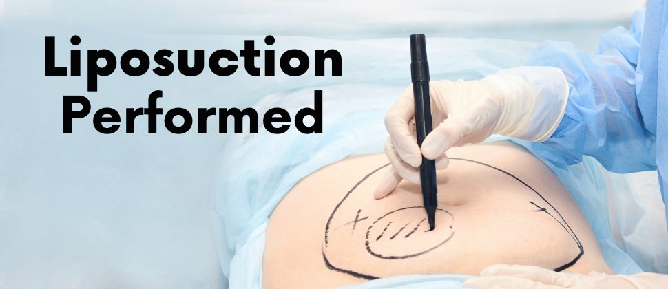 How Is Liposuction Performed